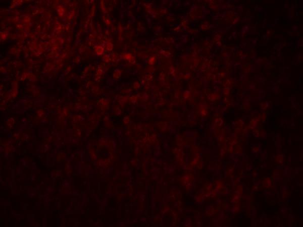 Immunofluorescence of MAGEA4 in human breast cancer tissue with MAGEA4 antibody at 20 μg/ml