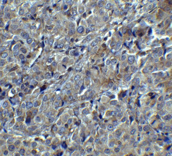 Immunohistochemistry of MAGEA4 in human breast tumor with MAGEA4 antibody at 5 μg/mL