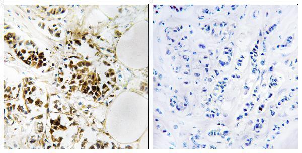 Immunohistochemistryt analysis of paraffin-embedded human breast carcinoma, using RGS5 Antibody