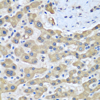 Immunohistochemistry of paraffin-embedded human liver cancer using GFM1 antibody  at dilution of 1:100 