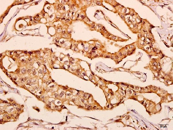 Immunohistochemistry (IHC) analyzes of GNPAT (F365) pAb in paraffin-embedded human breast carcinoma tissue at 1:50