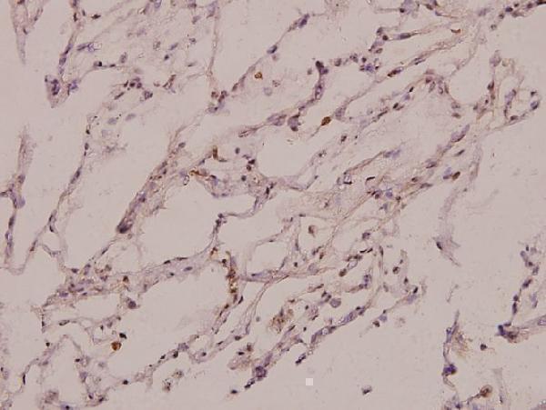 Immunohistochemistry (IHC) analyzes of PSMC3 (V306) pAb in paraffin-embedded human lung carcinoma tissue at 1:100
