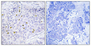 Immunohistochemical analysis of paraffin-embedded Human breast cancer