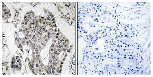 Immunohistochemistry analysis of paraffin-embedded human breast carcinoma tissue, using RAB3GAP2 Antibody