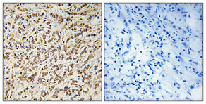 Immunohistochemical analysis of paraffin-embedded Human breast cancer