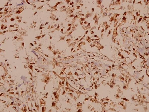 Immunohistochemistry (IHC) analyzes of GABAB R1 (I902) pAb in paraffin-embedded human breast carcinoma tissue at 1:50