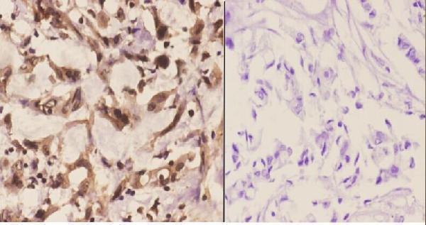 Immunohistochemistry (IHC) analyzes of PFKP (Q365) pAb in paraffin-embedded human breast carcinoma tissue at 1:50