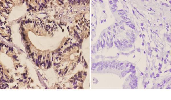 Immunohistochemistry (IHC) analyzes of PFKP (Q365) pAb in paraffin-embedded human colon carcinoma tissue at 1:50