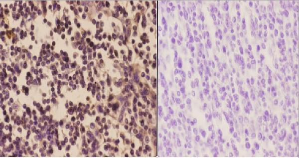 Immunohistochemistry (IHC) analyzes of PFKP (Q365) pAb in paraffin-embedded human tonsil carcinoma tissue at 1:50