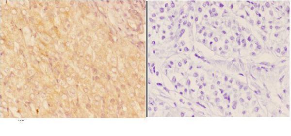 Immunohistochemistry (IHC) analyzes of ADAMTS18 pAb in paraffin-embedded human liver carcinoma tissue at 1:50,showing cytoplasm staining