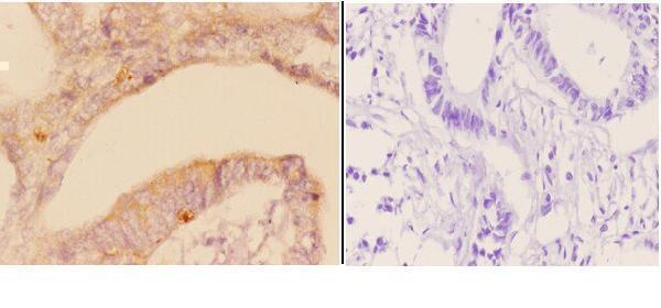 Immunohistochemistry (IHC) analyzes of ADAM23 pAb in paraffin-embedded human rectum carcinoma tissue at 1:50,showing strong cytoplasmic staining