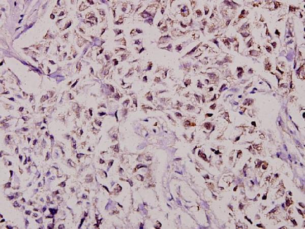 Immunohistochemistry (IHC) analyzes of CBP80 (R5) pAb in paraffin-embedded human breast carcinoma tissue at 1:100