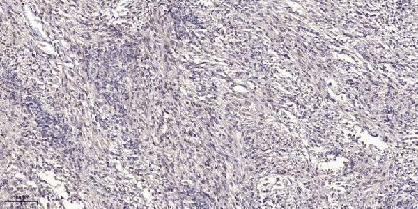 Immunohistochemical analysis of paraffin-embedded human small intestinal carcinoma tissue
