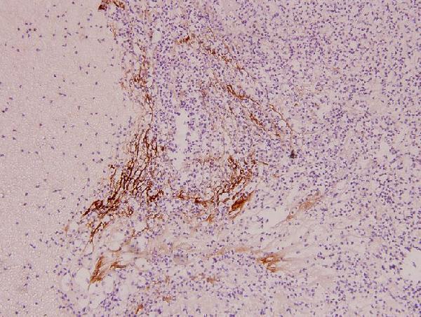 Immunohistochemistry (IHC) analyzes of IL-9R (L514) pAb in paraffin-embedded human liver carcinoma tissue at 1:100