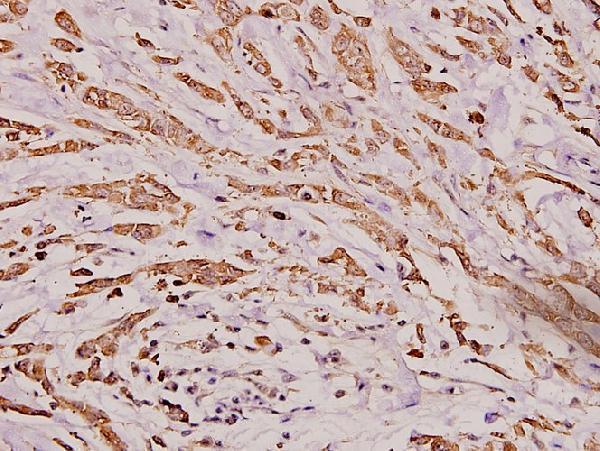 Immunohistochemistry (IHC) analyzes of IgA (Y276) pAb in paraffin-embedded human breast carcinoma tissue at 1:100