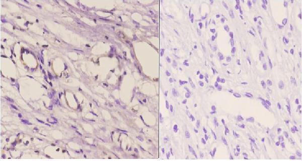 Immunohistochemistry (IHC) analyzes of Cadherin-16 (M810) pAb in paraffin-embedded human kidney carcinoma tissue at 1:50