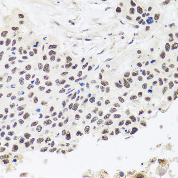 Immunohistochemistry of paraffin-embedded human lung cancer using RPP30 antibody  at dilution of 1:100 