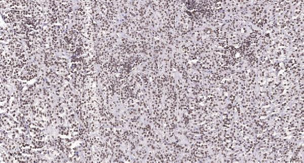 Immunohistochemical analysis of paraffin-embedded human Small intestinal stromal tumor