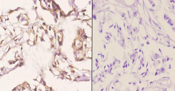 Immunohistochemistry (IHC) analyzes of RTCD1 pAb in paraffin-embedded human breast carcinoma tissue at 1:50