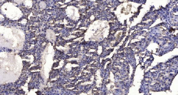 Immunohistochemical analysis of paraffin-embedded human liver cancer