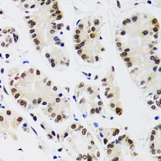 Immunohistochemistry of paraffin-embedded human gastric cancer using EDF1 antibody  at dilution of 1:100 