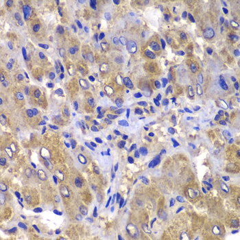 Immunohistochemistry of paraffin-embedded human liver damage using CARD10 antibody  at dilution of 1:100 