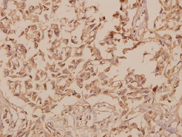 Immunohistochemistry (IHC) analyzes of hnRNP H (R192) pAb in paraffin-embedded human breast carcinoma tissue at 1:50