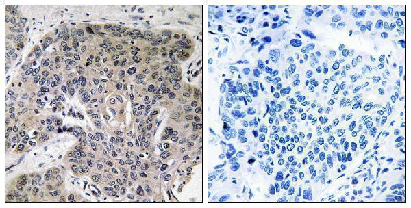 Immunohistochemistry analysis of paraffin-embedded human lung carcinoma tissue, using S100A3 Antibody