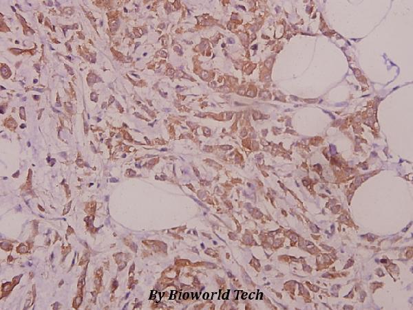 Immunohistochemistry (IHC) analyzes of eRF3a (D128) pAb in paraffin-embedded human colorectal carcinoma tissue at 1:50