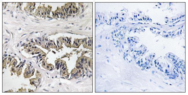 Immunohistochemistry analysis of paraffin-embedded human prostate carcinoma tissue, using GSPT1 Antibody