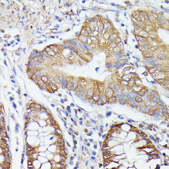 Immunohistochemistry of paraffin-embedded human colon carcinoma using TRIP4 antibody  at dilution of 1:100 