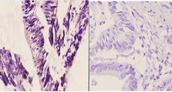Immunohistochemistry (IHC) analyzes of ASC-1 (G105) pAb in paraffin-embedded human colon carcinoma tissue at 1:50