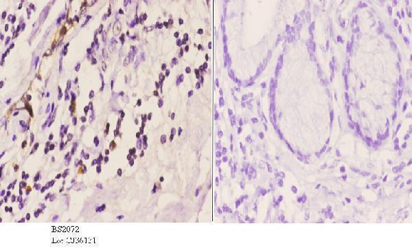 Immunohistochemistry (IHC) analyzes of ASC-1 (G105) pAb in paraffin-embedded human esophagus carcinoma tissue at 1:50