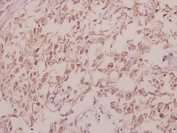 Immunohistochemistry (IHC) analyzes of Cdc40 (S209) pAb in paraffin-embedded human colorectal carcinoma tissue at 1:50