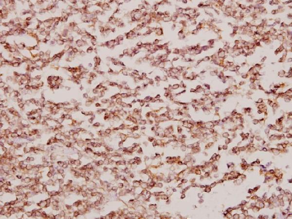 Immunohistochemistry (IHC) analyzes of BCKDK (E41) pAb in paraffin-embedded human tonsil carcinoma tissue at 1:50