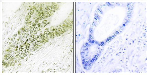 Immunohistochemistry analysis of paraffin-embedded human colon carcinoma tissue, using Ubinuclein Antibody