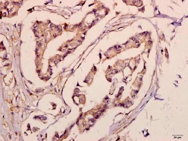 Immunohistochemistry (IHC) analyzes of ACSL6 (D531) pAb in paraffin-embedded human breast carcinoma tissue at 1:50