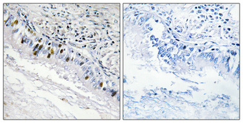 Immunohistochemical analysis of paraffin-embedded Human lung cancer