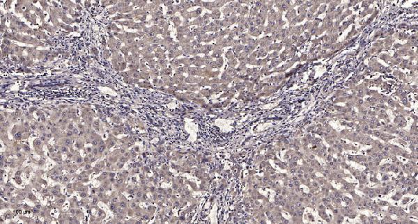 Immunohistochemical analysis of paraffin-embedded human liver cancer