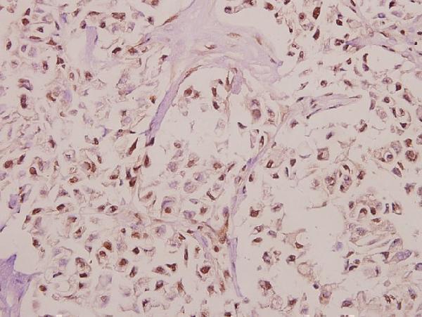 Immunohistochemistry (IHC) analyzes of RPL27A (V140) pAb in paraffin-embedded human colorectal carcinoma tissue at 1:50