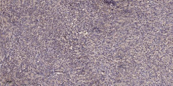 Immunohistochemical analysis of paraffin-embedded human Colon cancer
