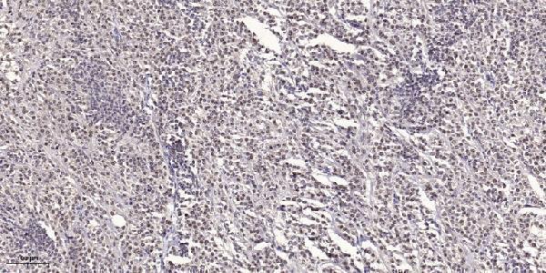 Immunohistochemical analysis of paraffin-embedded human small intestinal carcinoma tissue