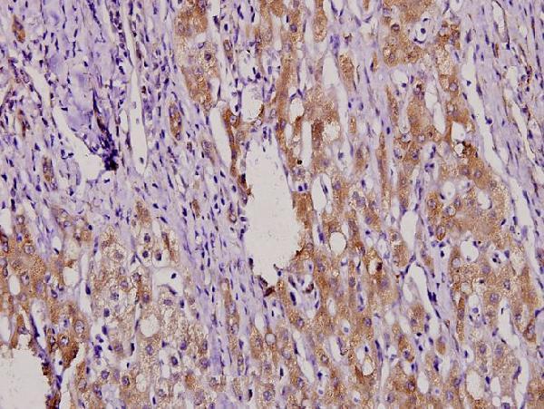 Immunohistochemistry (IHC) analyzes of MKP-4 (A174) pAb in paraffin-embedded liver cancer tissue at 1:100