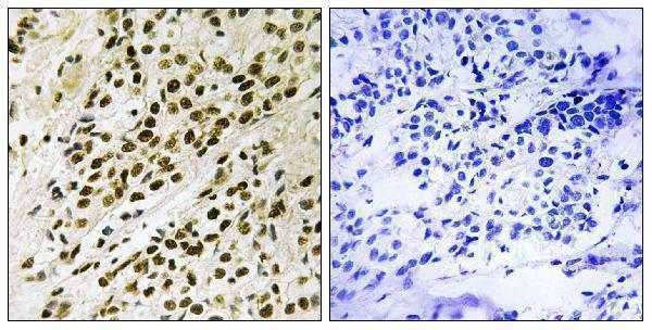 Immunohistochemistry analysis of paraffin-embedded human breast carcinoma, using MAPKAPK5 (Phospho-Thr182) Antibody