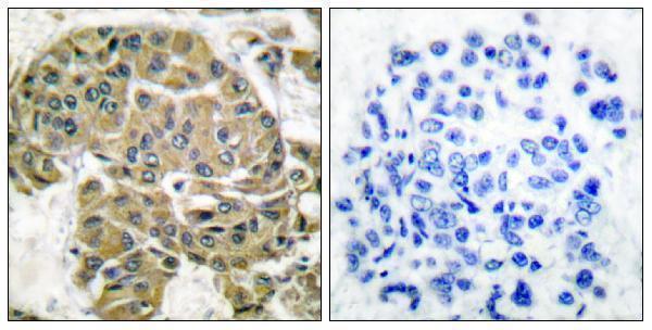 Immunohistochemistry analysis of paraffin-embedded human breast carcinoma tissue, using Mammaglobin B Antibody