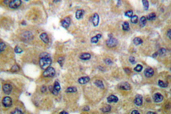 Immunohistochemistry (IHC) analyzes of Mammaglobin B (K23) pAb in paraffin-embedded human breast carcinoma tissue