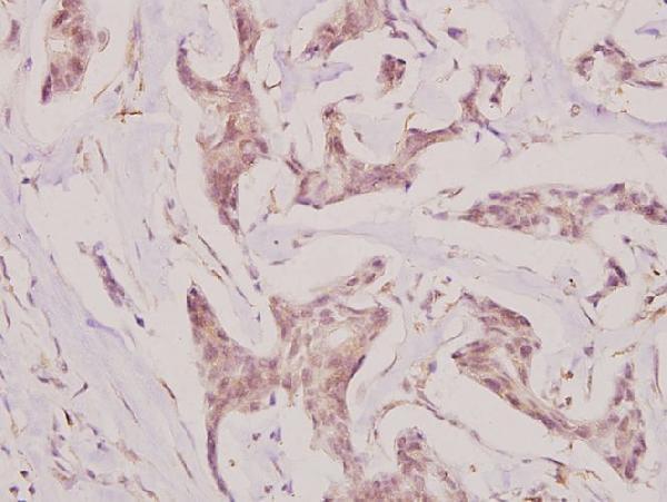 Immunohistochemistry (IHC) analyzes of UMP-CMP Kinase (E36) pAb in paraffin-embedded human breast carcinoma tissue at 1:100