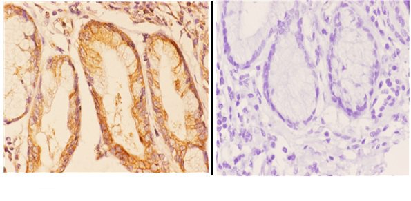 Immunohistochemistry (IHC) analyzes of COP ζ1 (I48) pAb in paraffin-embedded human esophageal carcinoma tissue at 1:50