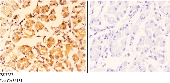 Immunohistochemistry (IHC) analyzes of COP ζ1 (I48) pAb in paraffin-embedded human stomach carcinoma tissue at 1:50