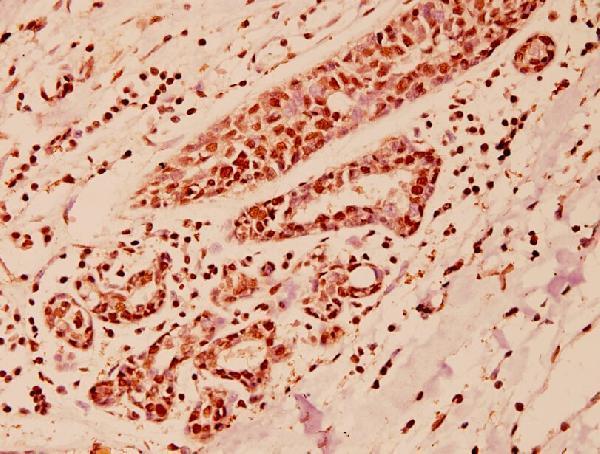 Immunohistochemistry (IHC) analyzes of COPS3 (M408) pAb in paraffin-embedded human breast carcinoma tissue at 1:100